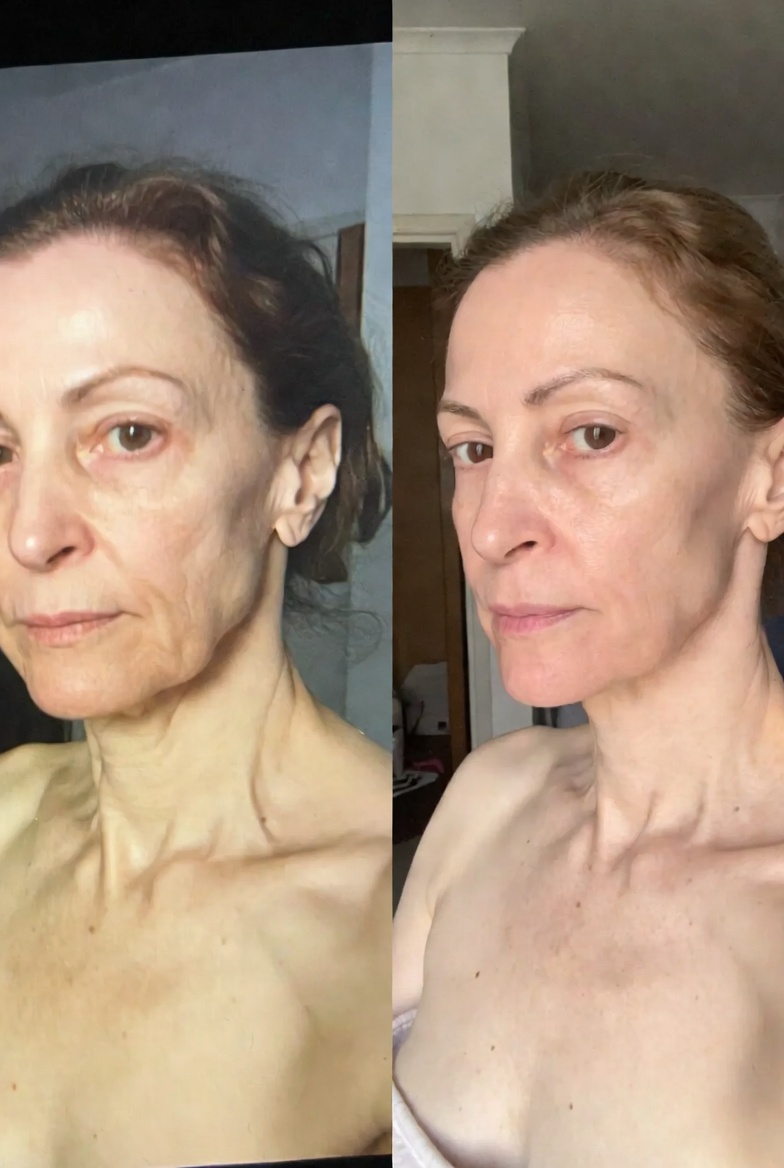 Marlene antes e depois do Programa Renascimento